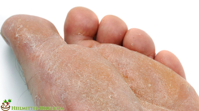 Heilmittel gegen Fußpilz