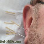Akupunktur gegen Heuschnupfen