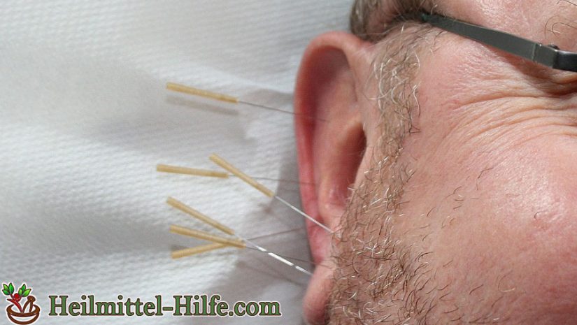 Akupunktur gegen Heuschnupfen