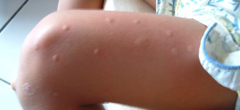 Heilmittel gegen Mückenstiche