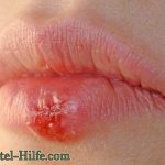 Hausmittel gegen Herpes und Lippenherpes