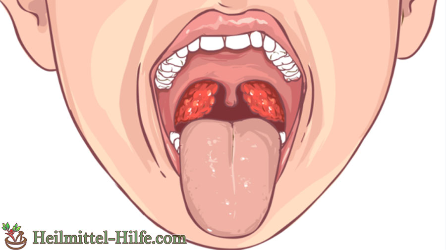 Mandelentzundung Kinder Mandelentzundung Tonsillitis