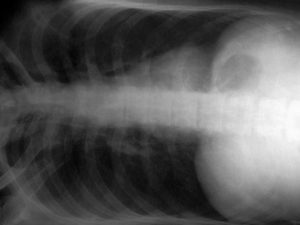 Röntgenbild einer chronischen Bronchitis