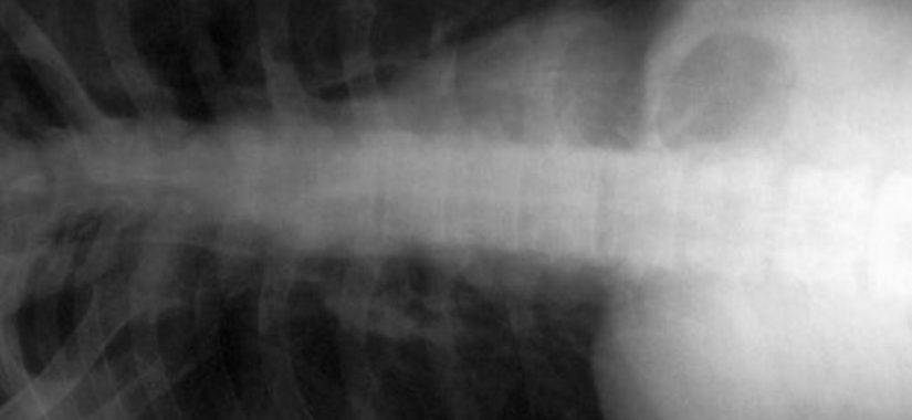 Röntgenbild einer chronischen Bronchitis