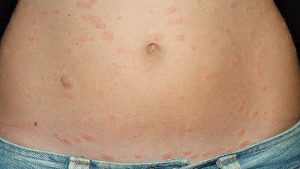 Schuppenflechten- psoriasis